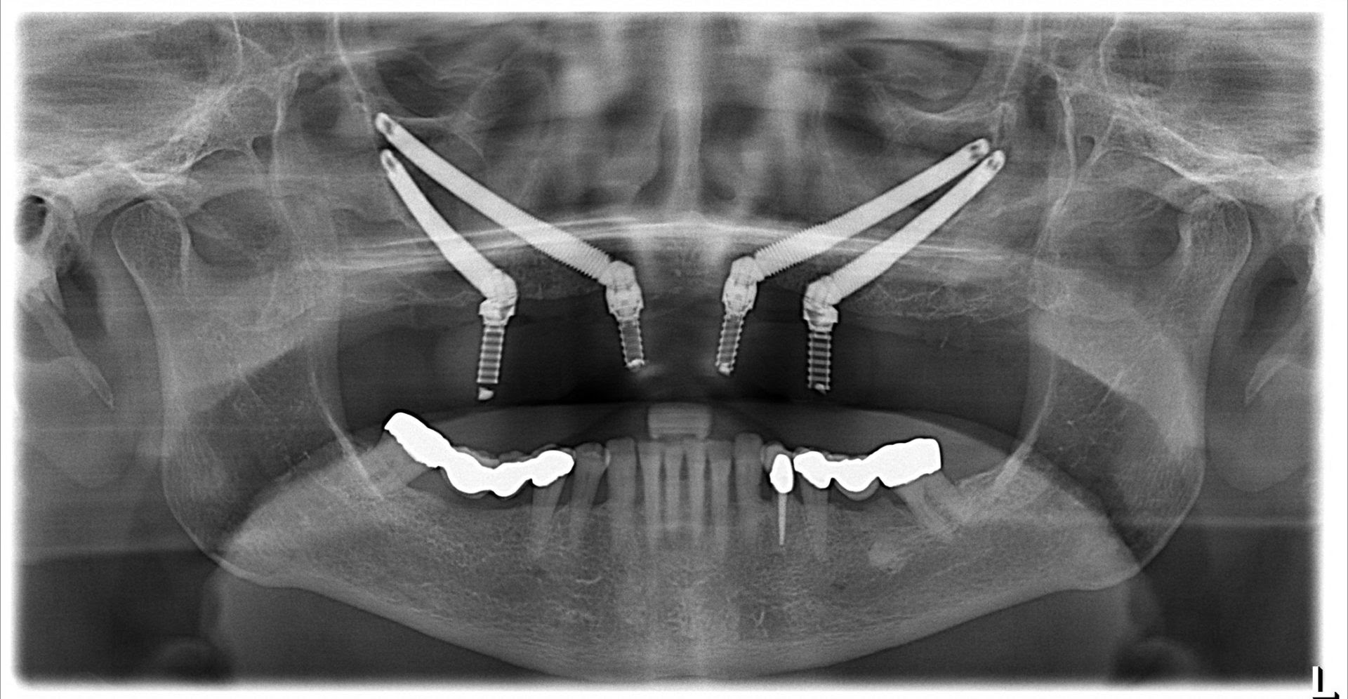 Zygomatic dental implants