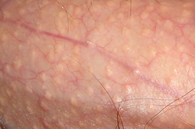  bumps on my penis and scrotum, how do I get rid of them? - Help.com