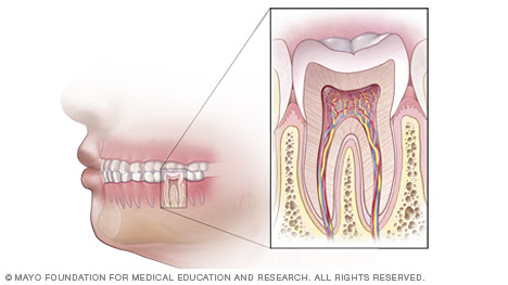 Root canal cheapest price
