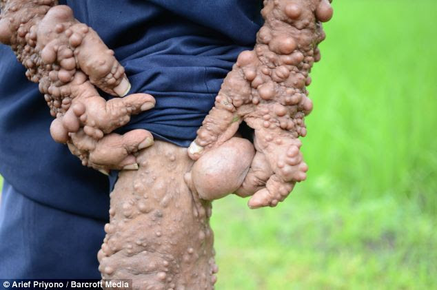 Slamet suffers constant pain and the tumours have started blocking his nostrils, making it difficult to breath