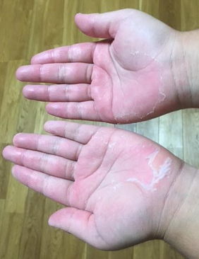 手の皮がむける意外な原因は 溶連菌でもなくオキアミだった