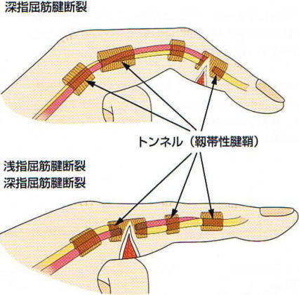 屈筋腱損傷 新鮮例 原因 病態