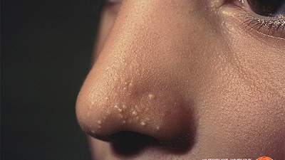 punca bintik putih di muka