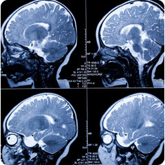 chiari malformation 2013 | just b.CAUSE