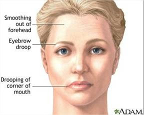 à¹à¸¡ à¸­à¸ à¸à¹à¸ à¸ à¹à¸à¸«à¸ à¸²à¸­ à¸¡à¸à¸²à¸à¸à¸£ à¸à¸ à¸ Bell S Palsy Pantip