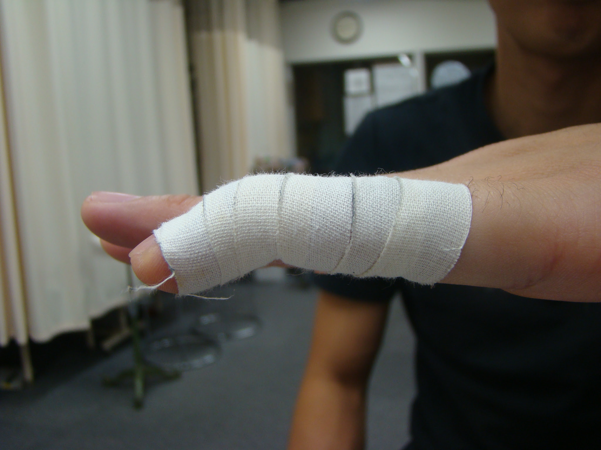 マレットフィンガー スタッフブログ 鎌倉市のスポーツ外傷 怪我治療なら大船接骨院