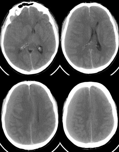 hematoma subdural crónico isodenso