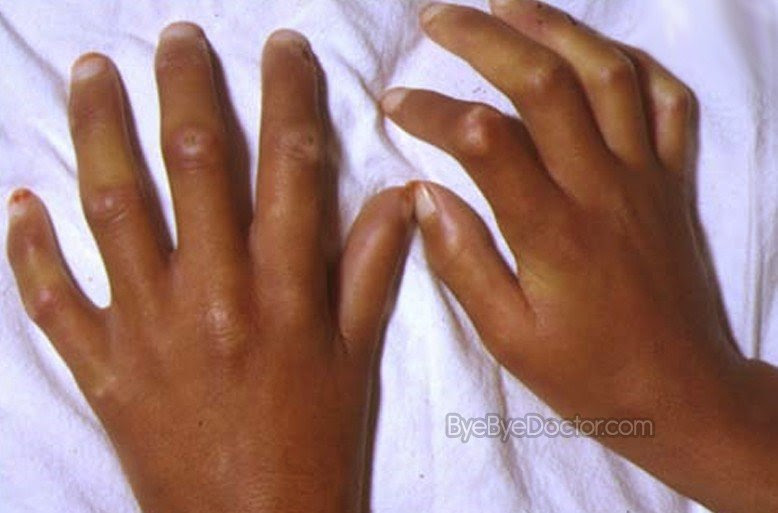 scleroderma Scleroderma