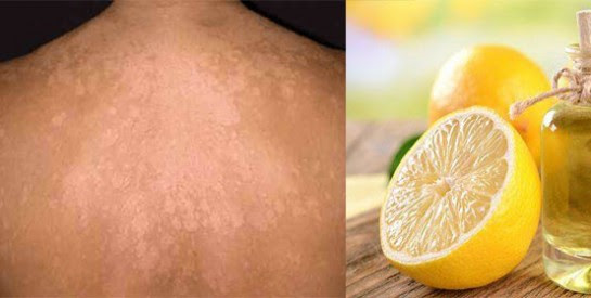 Le Citron Une Solution Pour Se Debarrasser Des Dartres Avec Efficacite Afriquefemme Com
