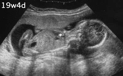 19w4d妊婦健診 妊婦はじめました