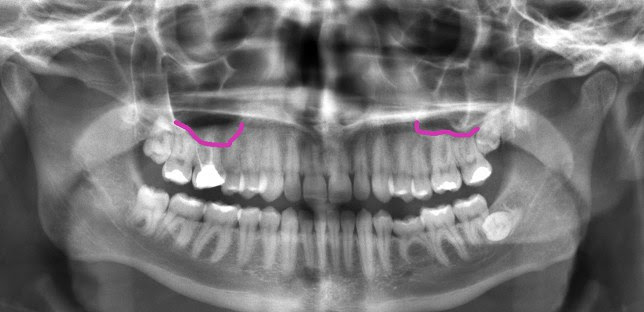 Tooth Pain and Sinuses