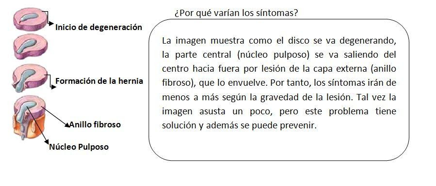 hernia3