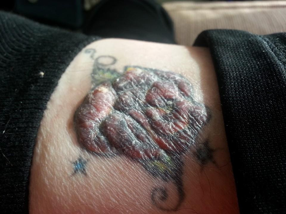 Cancer from a tattoo. - Imgur