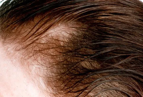 A woman shows signs of female-pattern baldness.