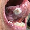 3 Types Of Skin Cancer Explained : ì¬ë§ê· ì ê±°ë°©ë², ì¹ë£ ììë³¼ê¹ì? :: ìë£ì©í¤í¸ : Skin cancer is by far the most common type of cancer.