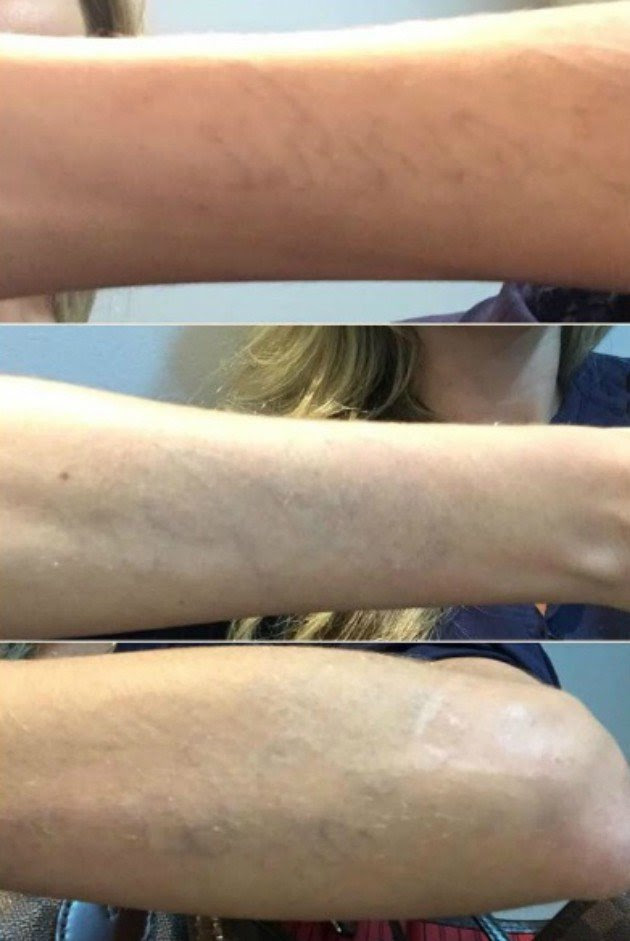 Antes de depois remoção de tatuagem que nao deram certo Barbara Evans Mostra Resultado Da Remocao De Suas Tatuagens Pro Corpo