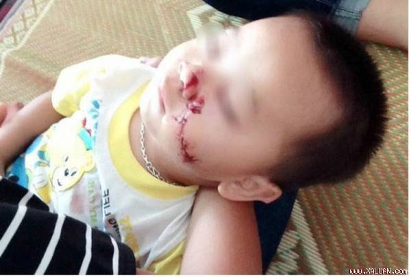 Hình ảnh cháu bé bị rách một vệt dài trên mặt khiến nhiều người xót thương.