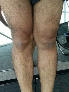 Acl手術後一か月 ほぼ普通に歩けるようになった かな Franklin Filbert