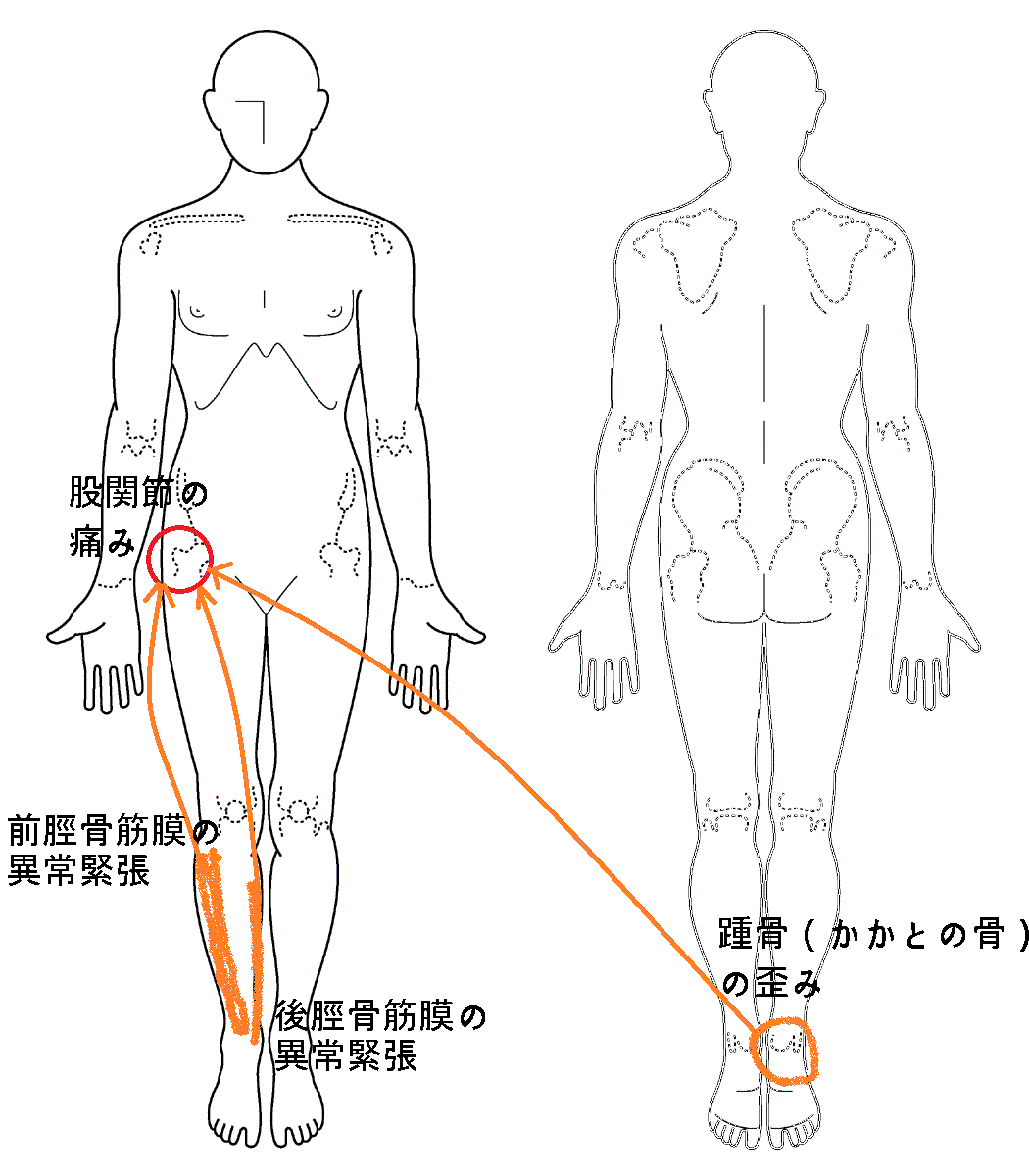 股関節 外側 痛い