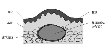俗にいう 脂肪のかたまり 品川区 あおよこ皮膚科クリニック