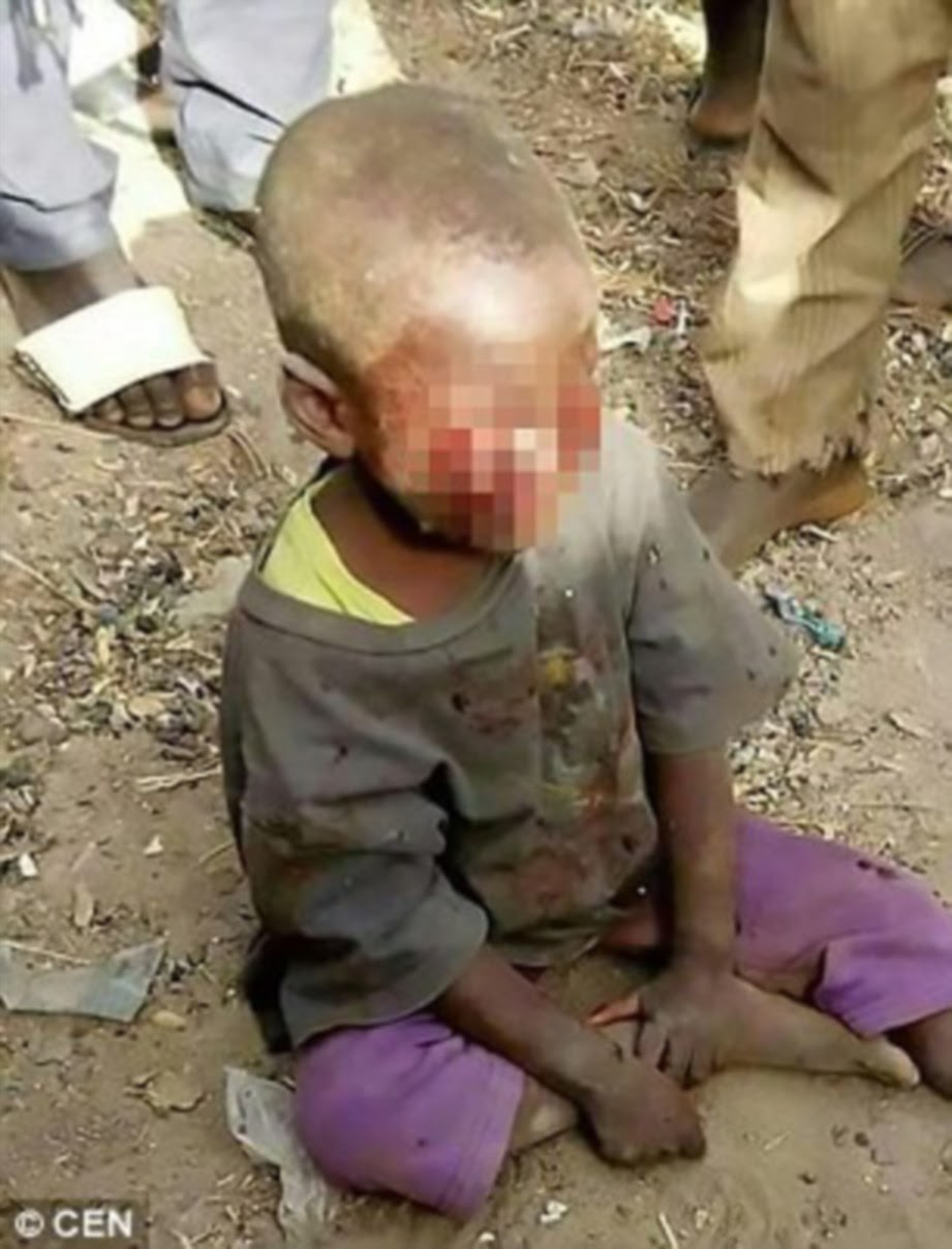 Wanita cungkil biji mata anak tiri umur 4 tahun sampai hancur sebagai hukuman kerana kencing malam