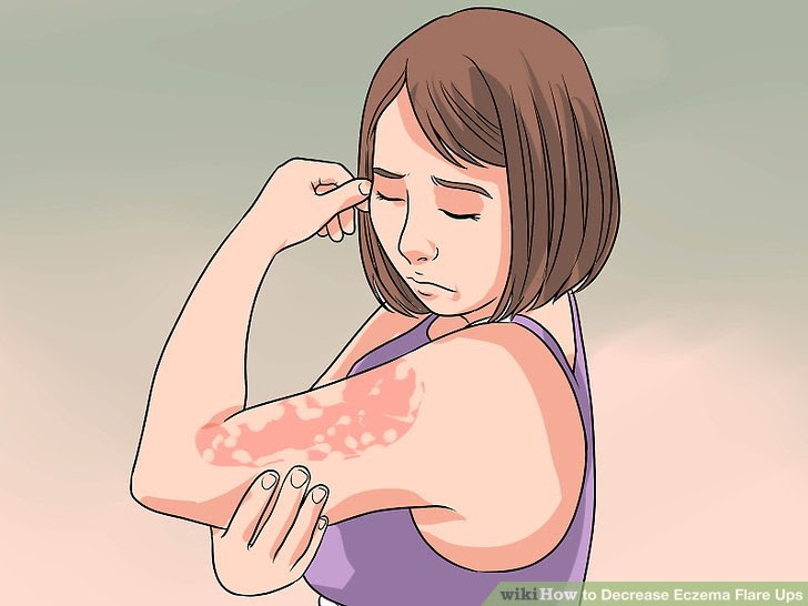 Decrease Eczema Flare Ups Step 1 Version 3.jpg