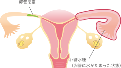 婦人科疾患 札幌白石産科婦人科病院 腹腔鏡手術 子宮内膜症専門外来サイト