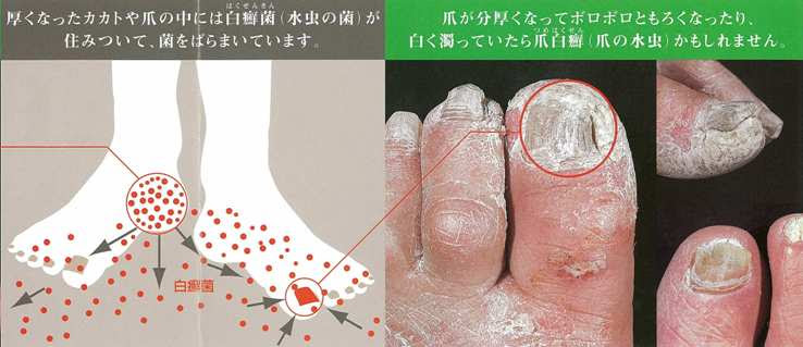 パレスクリニック ネイル外来 爪白癬 爪水虫 レーザー治療