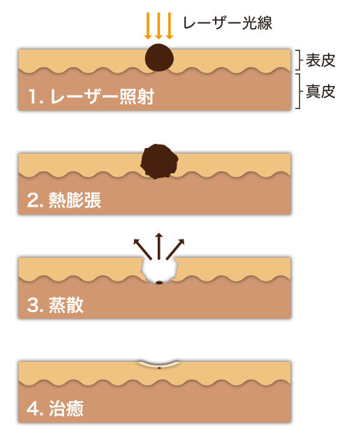 当山美容形成外科 イボ ほくろ治療