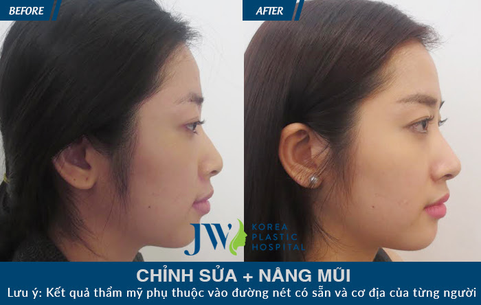 Khách hàng từng phẫu thuật mũi hỏng và may mắn khi tìm đến JW để được chỉnh sửa, đồng thời nâng mũi tạo hình dáng đẹp tự nhiên