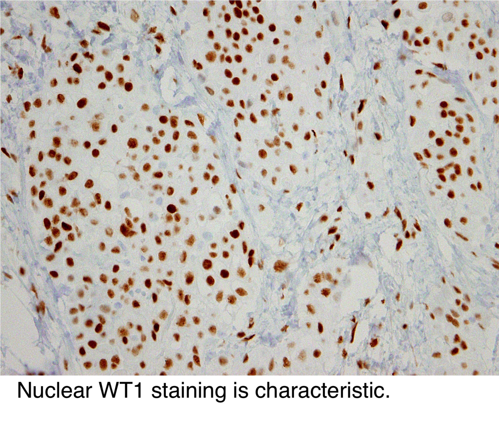 Pathology Outlines - Peritoneal malignant mesothelioma