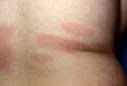 Tick bite with multiple
rashes Tick bite with multiple rashes