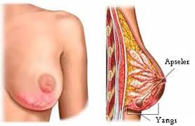 çatlak göğüs uçları meme başı çatlakları memede çatlağın olması göğüs ucu çatlağı