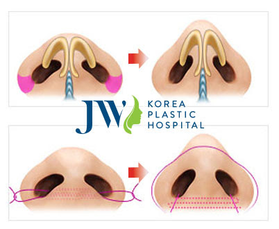 Thu gọn cánh mũi có ảnh hưởng gì không?