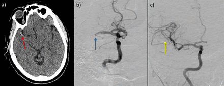 Revolution in acute ischaemic stroke care: a practical 