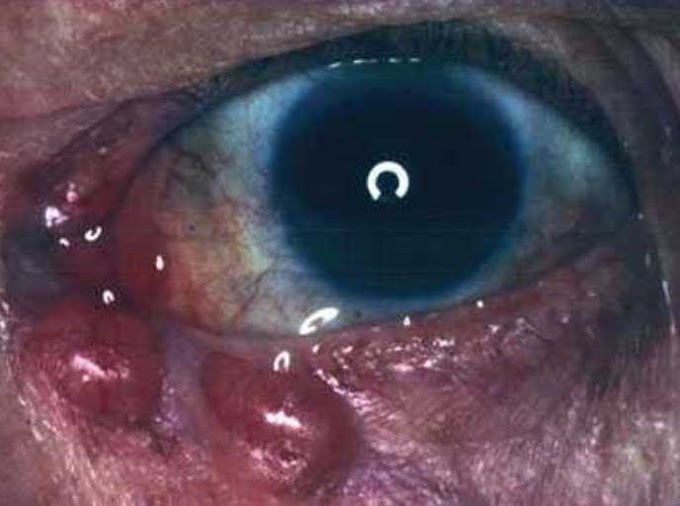 Skin Cancer Types Face / Postirradiation primary Kaposiâs sarcoma of the head and neck - Journal