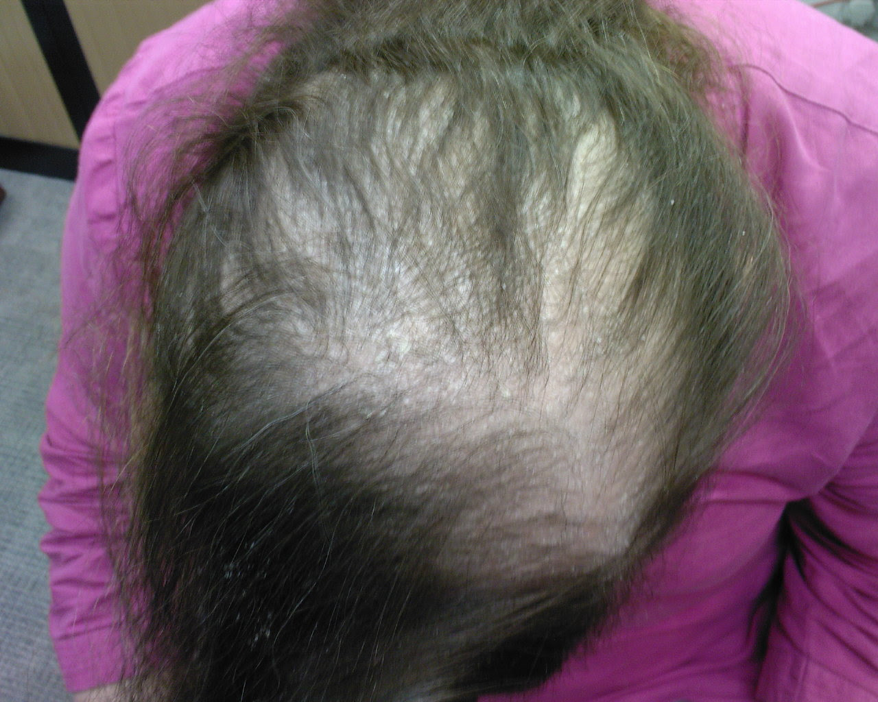 The Hair Loss Centre | After Just 3 Months Of Treatment ...