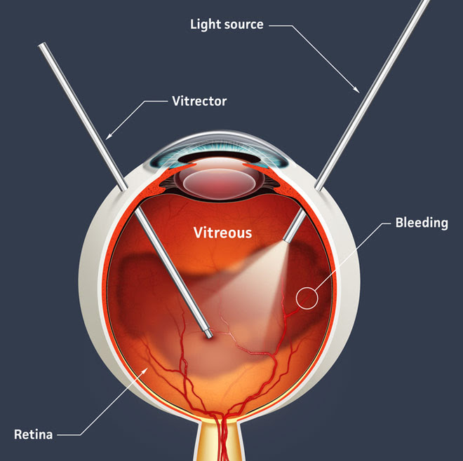 What is Pars Plana Vitrectomy? New Health Advisor