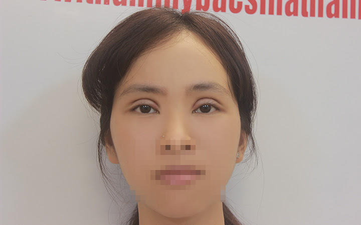 Thúy Duyên sau khi cắt mí mắt 1 tuần