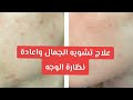 علاج تشويه الجمال والجسم والارق بسبب السحر والعين والمس الرقية السحر العلاج المجربات في العلاج