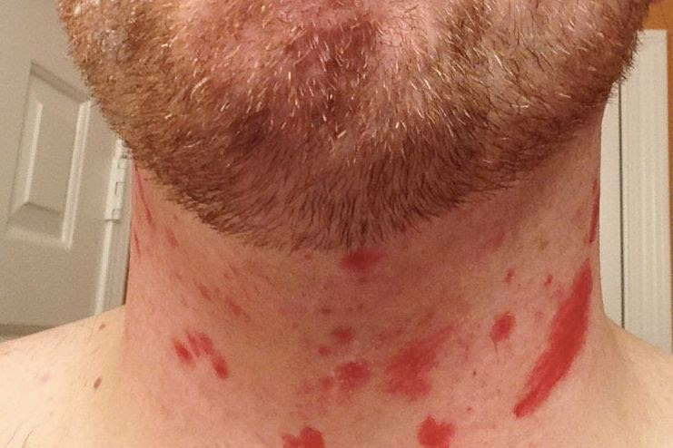 6 Best Home Remedies for Razor Bumps