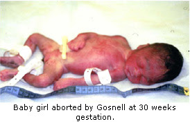 Image result for late term abortion