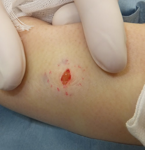 皮膚良性腫瘍 おでき 医療法人社団 美啓会 ぎふスキンケアクリニック 岐阜市の形成外科 美容外科 美容皮膚科