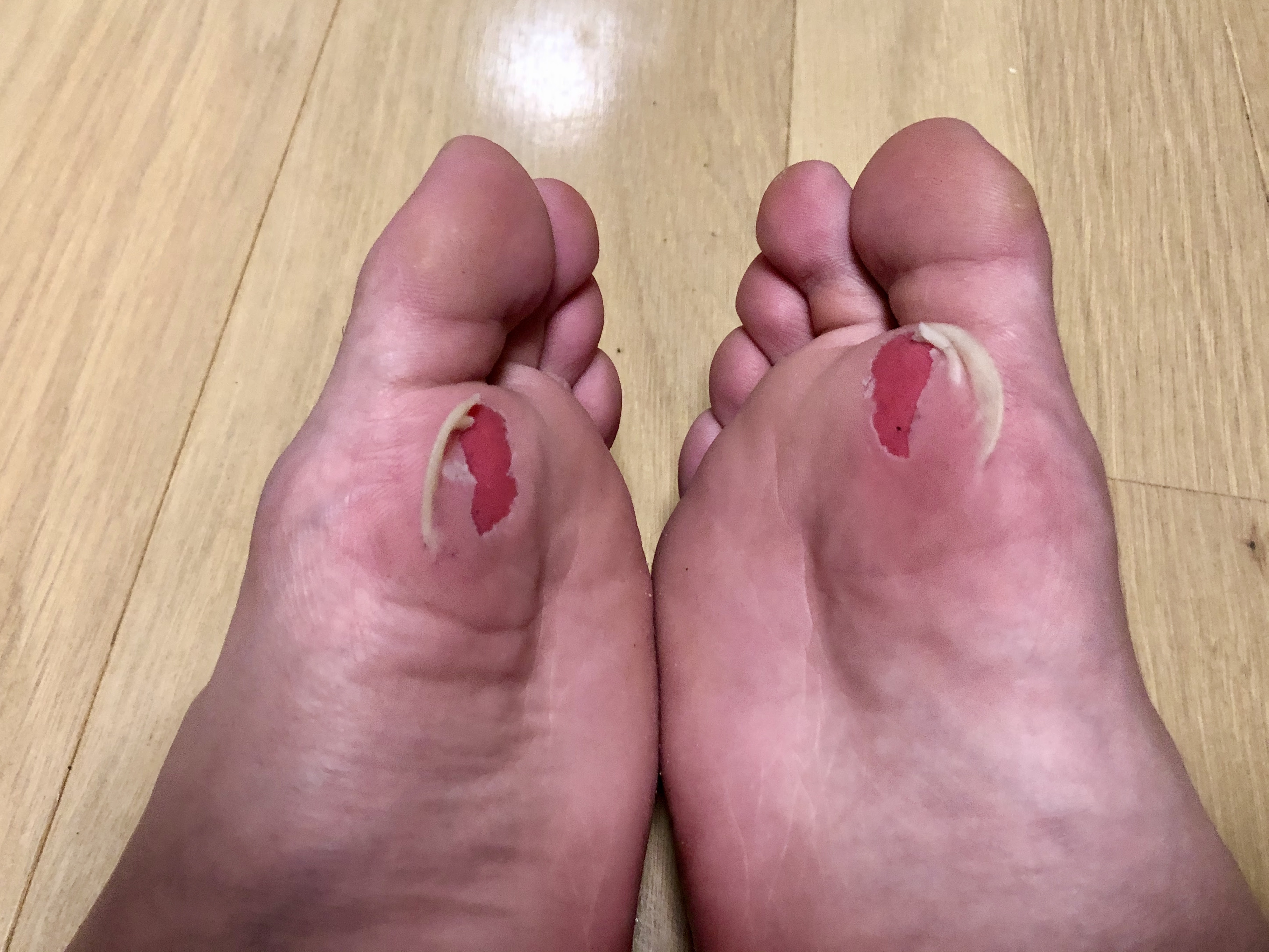30代のフットサルは楽しいが 危険と隣り合わせ 皆さんも気を付けてください デュアルライフ鍼灸師かきのきぞの