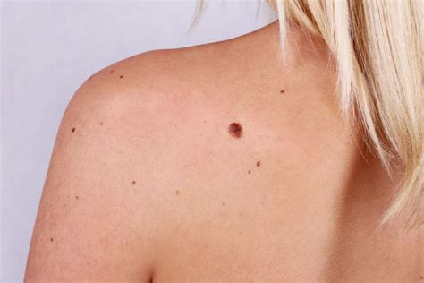 You can thin and smooth the callus with a pumice stone or emery board. Can you freeze a mole off with wart remover