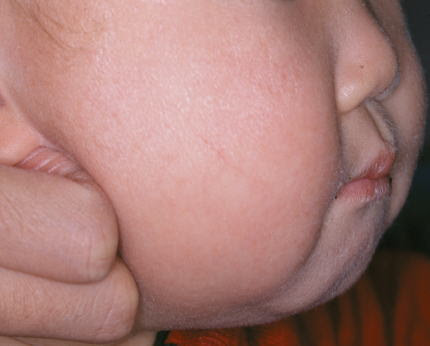 4 アトピー性皮膚炎の症状