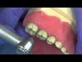 Preformed metal crown-preparation