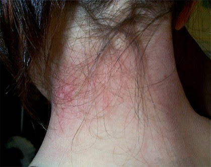 Eczema Atopique De L Enfant Dr Varlet