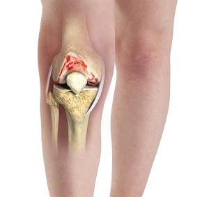 Knee Arthritis Treatment Wollongong | Osteoarthritis Flare ...