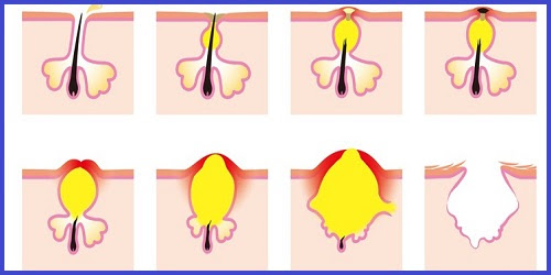 ... how to get rid of acne cyst let s clarify this acne is a term that